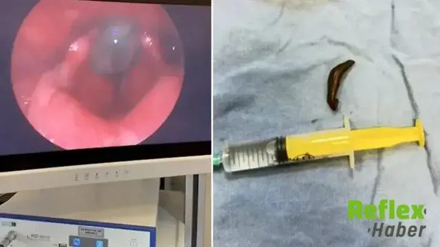 Çeşme suyu içen adamın boğazından canlı sülük çıkarıldı