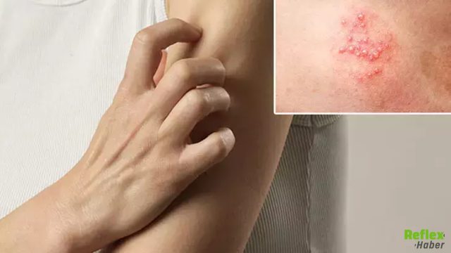 50 Yaş Üstü İçin Uyarı Zona Hastalığı Nasıl Ortaya Çıkar