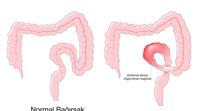 Bağırsak Düğümlenmesi Nasıl Anlaşılır? Dikkat Edilmesi Gereken İşaretler