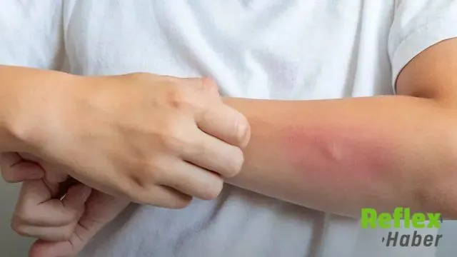 Egzamanın Görünür Etkileri Sosyal Yaşamı Zorlayabiliyor