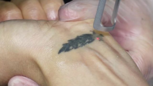 Biten aşklar dövme sildirmenin birinci nedeni