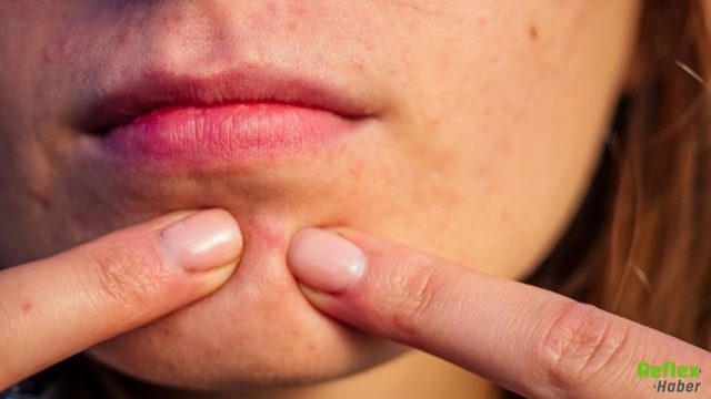 Çenede Sivilce Oluşumunun Nedeni Nedir