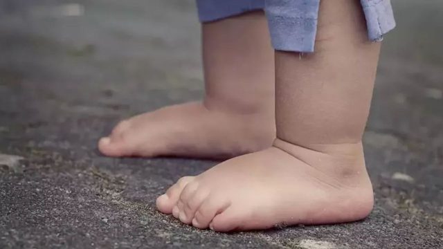 Çocuklarda düztabanlık nasıl anlaşılır?