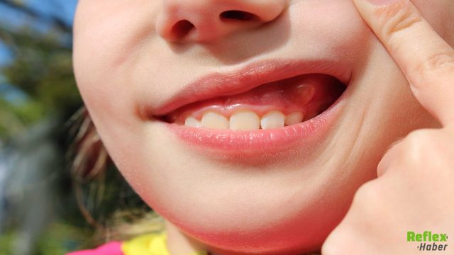 Diş Eti Şişmesine Dikkat Bu Belirtileri Göz Ardı Etmeyin