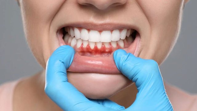 Düşük bağışıklık sistemi veya stres diş etlerini etkileyebilir