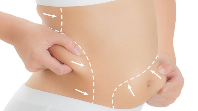 Liposuction Nedir? Yöntemleri Nelerdir?