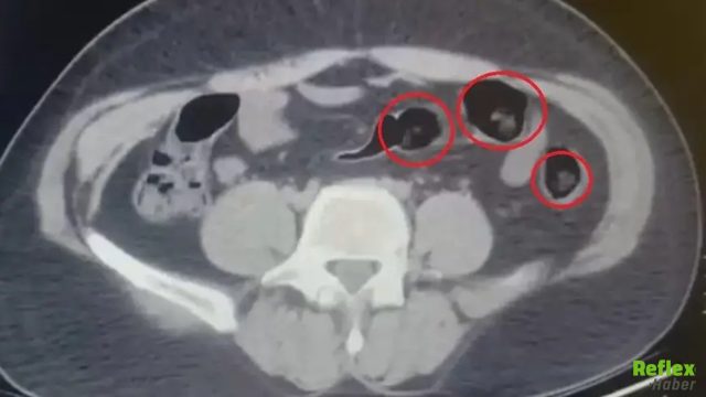 Polis Şüphelendi, Gerçek Hastanede Ortaya Çıktı! Midesinden 62 Paket Uyuşturucu Çıkarıldı