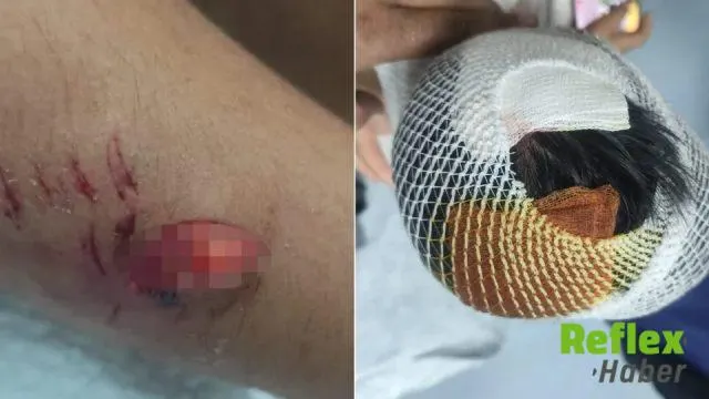 Viranşehir’de Saldırıya Uğrayan Öğrencinin Başına 15 Dikiş Atıldı