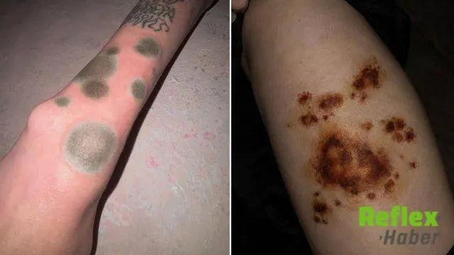 Rusya'da Z Kuşağının Çürümüş Deri Görünümlü Dövmeleri Gündemde