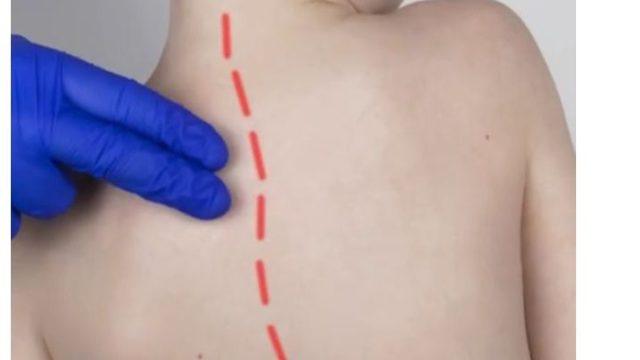 Skolyoz tedavisinde erken tanı ve tedavi çok önemli