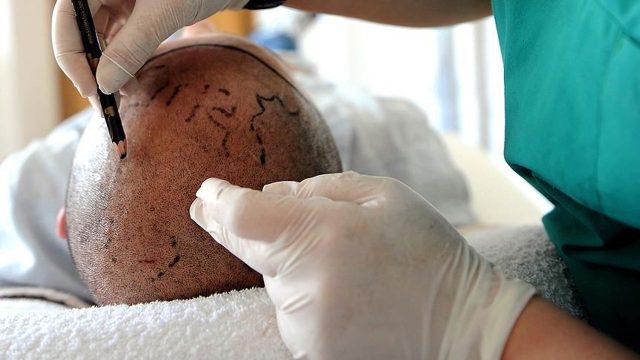 Tabip Odası duyurdu: Hekim olmadığı halde saç ekimi yapan kişiye hapis cezası verildi
