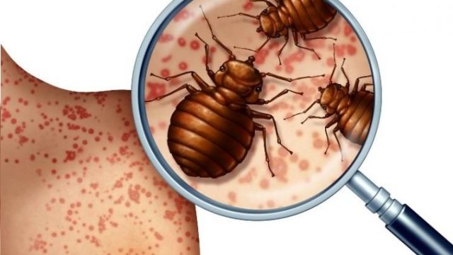 Tahtakurusu ısırması, belirtileri, alerjisi, teşhisi ve tedavisi nasıl yapılır?