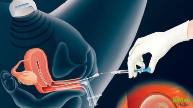 Tüp Bebekte En Kritik Aşama Embriyolar Rahme Nasıl Yerleştirilir